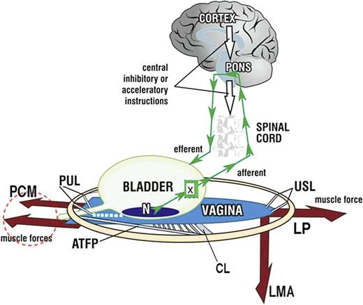 Binary model for bladder control by 2 opposing reflexes, either closure or micturition. Schematic 3D sagittal view, system in normal closed mode. PCM, pubococcygeus muscle; LP, levator plate; LMA, conjoint longitudinal muscle of the anus; PUL, pubourethral ligament; USL, uterosacral ligament; N, urothelial stretch receptors; CX, cervix; CL, cardinal ligament; ATFP, arcus tendineus fascia pelvis; small green arrows, afferent and efferent nerves; white arrows, cortical suppression. Control of SUI: PCM closes the distal urethra from behind; LP/LMA stretches the proximal urethra around PUL to close the bladder neck. Control of urge: afferent impulses “X” from stretch receptors “N” signal bladder fullness reflexly suppressed cortically (white arrows) or peripherally by a musculo‐elastic mechanism, vaginal stretching by 3 striated pelvic muscles contracting against PUL and USL. Micturition: the closure reflex is shut down and the micturition reflex is activated. PCM relaxes. LP and LMA open out the posterior wall of the urethra (white broken lines below the urethra). Dysfunction: any lesion in the circuit can cause retention or loss of urge control: cortex; collagen loss in PUL, USL weakens pelvic muscle contractile strength; excitation of “N” by inflammation, tumour; MS in afferent nerves (retention), MS in efferent nerves (leakage).