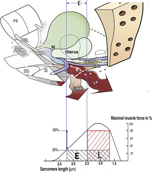 How ligament laxity diminishes striated muscle force? Upper image: Anatomy. If USLs are overstretched by length “E,” the uterus prolapses, LP and LMA lengthen by “E.” The wavy shape of LP and LMA indicate diminution of contractile strength. Lower image: Sarcomere (striated muscle fibres). A striated muscle contracts optimally of a short length only (L). Elongation of the muscle to “E” diminishes contractile force. USL, uterosacral ligament; LP, levator plate; LMA, conjoint longitudinal muscle of the anus. Refer to the image caption for details.