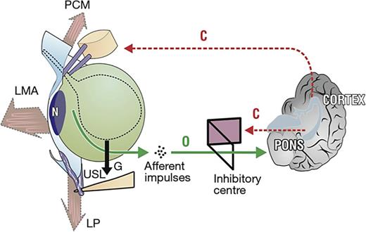 The anatomy of nocturia pelvic muscles (large arrows) is relaxed. As the bladder (broken outline) fills, it is distended downwards by gravity “G.” If the uterosacral ligaments (USLs) are weak, they continue to descend until the stretch receptors “N” are stimulated, activating the micturition reflex “O” once the cortical closure reflex “C” has been overcome. PCM, pubococcygeus muscle; LP, levator plate; LMA, conjoint longitudinal muscle of the anus. Refer to the image caption for details.