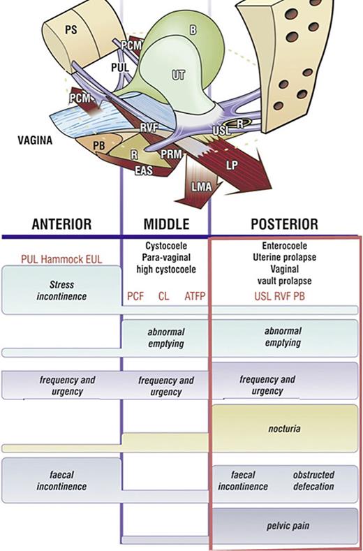 Pictorial diagnostic algorithm. Symptoms indicate which ligaments are damaged. Tick every box where a symptom occurs, and the diagnosis of ligament and damage-associated prolapse appears. The rectangle indicates the symptoms associated with USL laxity. The height of the bar indicates the probability of association of a symptom with a particular zone. The connective tissue structures causing prolapse and pelvic symptoms fall naturally into 3 zones. Anterior zone: external meatus to bladder neck. Middle zone: bladder neck to anterior cervical ring. Posterior zone: posterior cervical ring to PB. CPP and nocturia are uniquely caused by USL laxity, stress urinary incontinence by PUL, pubourethral ligament; hammock, suburethral vagina. EUL, external urethral ligament; CL, cardinal ligament; PCF, pubocervical fascia; ATFP, arcus tendinous fascia pelvis; PB, perineal body; RVF, rectovaginal fascia; USL, uterosacral ligament.