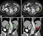a Case study of a patient presenting with a left-sided renal tumor (arrow). Segmentations of the renal tumor (red) and both kidneys (green overlay) are shown on axial CT (b) and 3D reconstructions (c, d).
