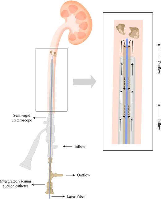 The left panel shows the overall structure of the semirigid ureteroscope with integrated vacuum suction catheter. The right panel presents a magnified view of the working channel, demonstrating the flow dynamics of irrigation fluid (solid arrows) and the vacuum suction effect (dashed arrows) during operation.