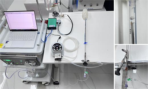 Left: Overview of the experimental setup showing the integrated system including laptop for data acquisition, pressure monitoring device (green box), irrigation pump, and artificial kidney model with pressure sensors. Upper right: Magnified view of the ureteroscope tip demonstrating the internal structure near the simulated proximal ureteral stone. Lower right: Detailed v iew of the vacuum-assisted system connection, showing the integration of the vacuum suction catheter with the ureteroscope.