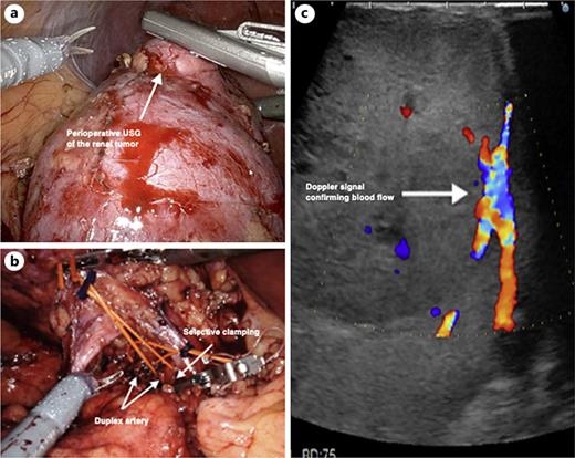 (a) Perioperative ultrasonography of the renal tumor (b) Duplex renal artery and selective clamping (c) Doppler signal confirming residual blood flow