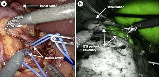 (a) Renal tumor and duplex renal artery during hilar dissection (b) Perfusion boundary visualized using ICG fluorescence imaging