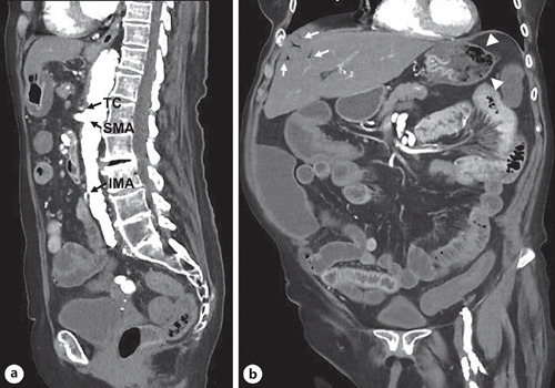 CT findings: arterial phase. a Sagittal reformation of the contrast-filled aorta – note subtotal stenosis of celiac trunk (TC), prominent superior mesenteric artery (SMA), and stenosed inferior mesenteric artery (IMA). b Coronal reformation – note the intrahepatic portal gas, indicated by arrows. The source appeared to be intramural gas formation in the stomach, indicated by arrowheads. The inner lining of the lesser curvature is well contrasted, while the greater curvature lacked contrast uptake. Also note the thickened sigmoid colon in the left lower quadrant showing little contrast uptake.