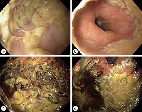 Endoscopic findings. a Confluent fibrinous plaques on ulcerated esophageal mucosa. b Abrupt transition at the gastroesophageal junction. c, d Map-like superficial gastric necrosis in the antegrade view (c) and in the inverse view (d).