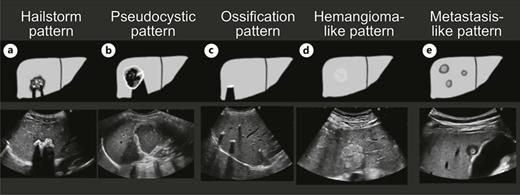 Ultrasound classification of alveolar echinococcosis. a Storm and hail pattern: the typical hailstorm appearance is characterized by indistinct, irregular boundaries, nonhomogeneous pattern and hyperechoic formations. b Pseudocystic pattern: pseudocystic alveolar echinococcosis lesions are primarily characterized by an hyperechoic, irregular, and nonhomogeneous rim that is non-vascularized at power Doppler and color-coded duplex ultrasonography. It may appear to be >10 mm in thickness. There is a hypo- or anechoic, often nonhomogeneous central zone that may contain hyperechoic material. c Ossification pattern: the ossification pattern presents with solitary or grouped, mostly sharply delineated lesions with dorsal acoustic shadow. Very large ossification-type AE lesions represent a rarity. Both uni- and multifocal involvement is possible. d Hemangioma-like pattern: sonomorphologically, the lesions present as a relatively clearly demarcated nonhomogeneous tumor that appears hyperechoic in comparison with the surrounding hepatic parenchyma. Echogenicity ranges from slightly and nonhomogeneously hyperechoic to strongly and homogeneous hyperechoic. e Metastasis-like pattern: mostly hypoechoic, these lesions exhibit as a typical characteristic-compared to typical hepatic metastases (e.g., of colorectal cancer)-the absence of the halo phenomenon. Instead, there is a central, hyperechoic, nonhomogeneous scar.