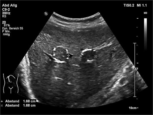Example of histologically confirmed E. multilocularis liver masses that are not classifiable according to the EMUC ultrasound classification.