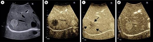 a True hemangioma in B scan. c, d Typical contrast behavior of a true hemangioma with nodular ring enhancement in the arterial phase (b) complete iris diaphragm phenomenon and markedly more echogenic presentation of the hemangioma compared to the adjacent liver tissue in the late phase after administration of 1.6 mL SonoVue.