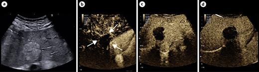 a Image of a hemangioma-like pattern in alveolar echinococcosis. b In contrast to a true hemangioma, contrast-enhanced ultrasound after administration of 1.6 mL SonoVue shows only rim enhancement in the arterial phase. In the portal venous phase (c) and in the late phase (d), the echinococcus lesion does not absorb any contrast medium and thus shows a typical “black hole sign.”