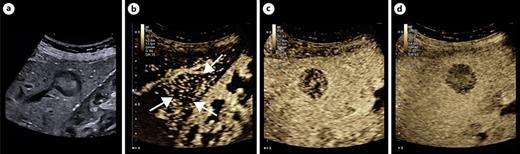Contrast-enhanced ultrasound of a histologically confirmed metastasis in breast carcinoma of the liver after administration of 1.6 mL SonoVue. a In the B scan, the mass is echogenic with a halo phenomenon. In the arterial phase (b), chaotic contrast uptake and a clear wash-out phenomenon in the portal venous (c) and late phase (d). The lesion is never echogenic in the sense of a “black hole sign” in AE during the entire contrast medium phase, as shown below.