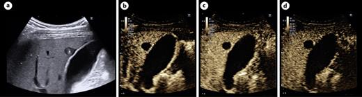 Contrast-enhanced ultrasound of a histologically confirmed mass of the metastatic pattern of hepatic AE after administration of 1.6 mL SonoVue. In the B scan (a), the mass cannot be differentiated from a true metastasis. During the entire contrast medium phase, the lesion does not absorb any contrast medium in the arterial, portal venous and late phases in the sense of a “black hole sign” (b–d).