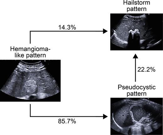 A change in pattern was seen exclusively for AE lesions initially classified as hemangioma-like or pseudocystic. A total of 70% (7/10) of AE lesions initially classified as hemangioma-like showed a relevant change in pattern over time, and 85.7% (6/7) of these were secondarily classified as having a hailstorm pattern, with the remainder (1/7; 14.3%) classified as having a pseudocystic pattern. A total of 22.2% (2/9) of AE lesions initially classified as pseudocystic showed a relevant change in pattern over time and were classified as having a hailstorm pattern.