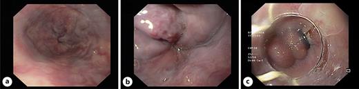 Ligation of esophageal varices. a, b Esophageal varices grade 2 with red cherry spots. c Esophageal varices with successful rubber band application.