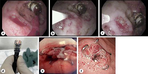 Bleeding ulcers. a Seven months old infant with 5.2 kg body weight with an anastomosis stricture (2 mm lumen) after long-gap esophagus atresia (Voigt 3b) surgery and a bleeding gastric ulcer. The ulcer was only reachable after balloon dilatation of the esophageal stricture performed in the same session using a baby endoscope (Pentax FG16V, working channel 2.0 mm, outer diameter 6 mm). The working channel of 2.0 mm only allowed injection therapy with suprarenin 1:10,000 (b, c) as endoscopes with a larger working channel could not pass the stricture. OTSC application is a recently available alternative in gastrointestinal bleeding therapy (d). An OTSC placed on a duodenal ulcer (e) and a gastric ulcer (f). Compared to conventional hemostatic clips the OTSC strikes with a combination of increased tensile grasping strength of the clip jaws, an improved tissue bite with the additional positive effect of persistent blood flow through the grasped tissue which prevents necrosis and supports the healing process.