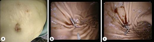 Hemoclip application. a Hemoclips can be applied to occlude persistent gastrostomy channels after deplacement of a PEG probe. b, c After electrocautery treatment of the gastric mucosa four clips were deployed. OTSCs can be used as an alternative in these cases.