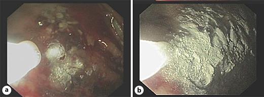 a, b Endoscopic hemostasis using powder sprays. An inert mineral powder causing coagulation through the increased activation of clotting (Hemospray®) is endoscopically applied to mechanically tamponade a bleeding gastric ulcer.
