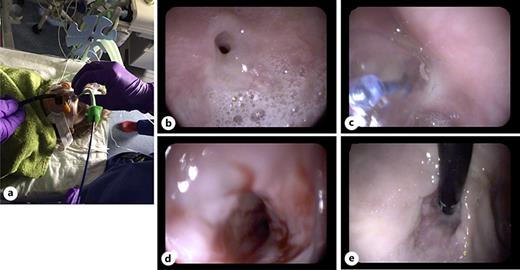 Postoperative management of a stricture after esophageal atresia using balloon dilatation. The balloon catheter is placed under endoscopic view via a transnasal tube (a) placed in the proximal esophagus in order to protect the hypopharynx during the insertion of the catheter as well as the dilation procedure. Central esophageal stricture located at the anastomosis region (b), insufflation of the balloon catheter after wire guided placement (c), adequate mucosal trauma after successful dilatation with retrograde view toward the fundus after passage of the stricture (d and e).