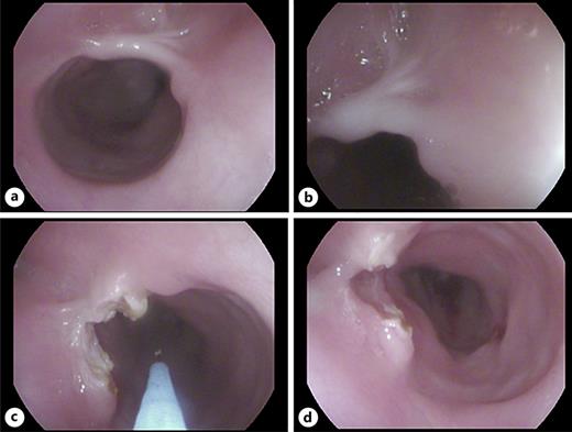 Electrocautery incisional therapy of stenosing fibrotic mucosal tissue. Stenosing fibrotic tissue at 12 o’clock (a) building a mucosal pocket (b) leading to dysphagia. Electrocautery incision (c) yielded a substantial gain in lumen width (d).