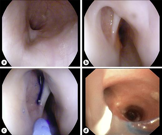 Recurrent esophagotracheal fistula – simultaneous EGD and bronchoscopy. a, b Anastomosis region with a small cavity opening up during careful inspection. Endoscopic application of methylene blue into this cavity (c) with simultaneous bronchoscopic detection of a blue-fainted tracheal mucus indicating an esophagotracheal fistula (d).