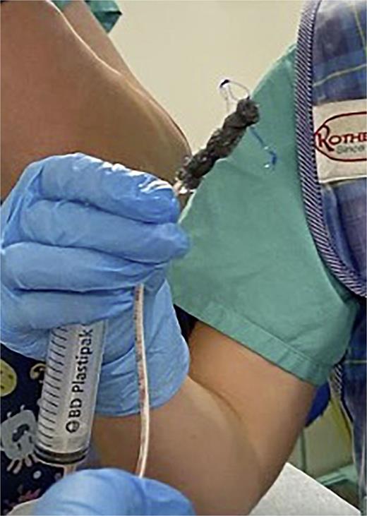 Esophageal perforation – sizing and preparing an endoscopic vacuum-assisted closure system (EVAC).